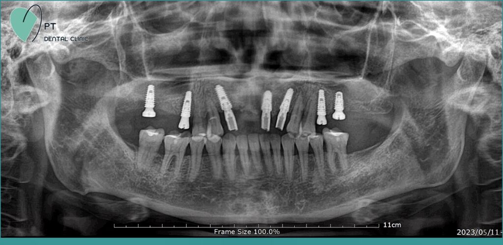 Địa điểm trồng răng Implant uy tín tại Bảo Lộc? Dia-chi-trong-rang-implant-uy-tin-tai-bao-loc-1024x500